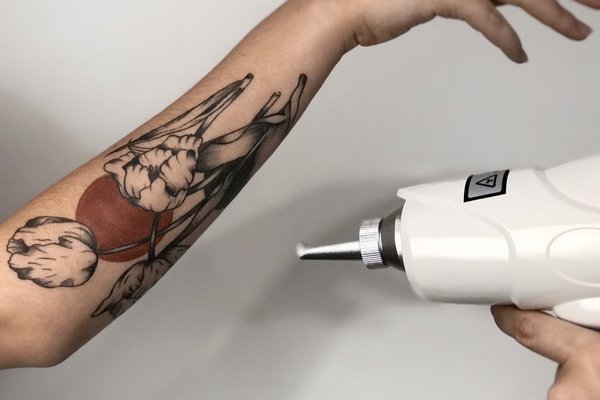 Eliminación de tatuaje en Granada