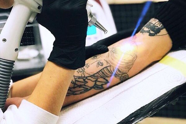Proceso de eliminación de tatuajes con láser