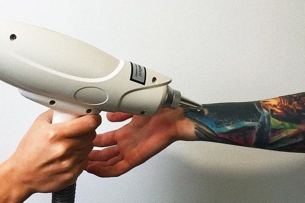 Eliminación de tatuajes